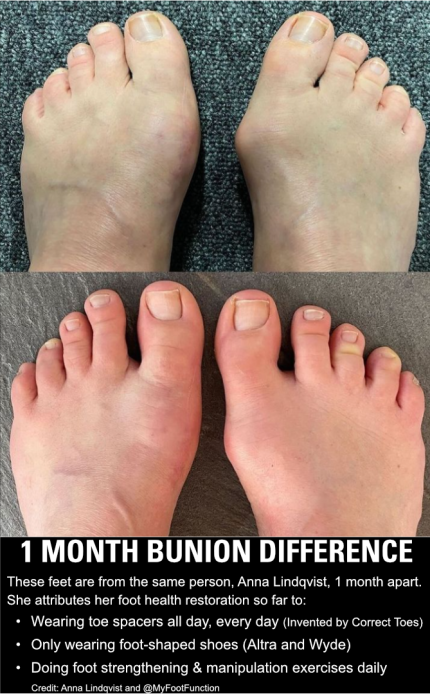 Bunion Change 1 Month