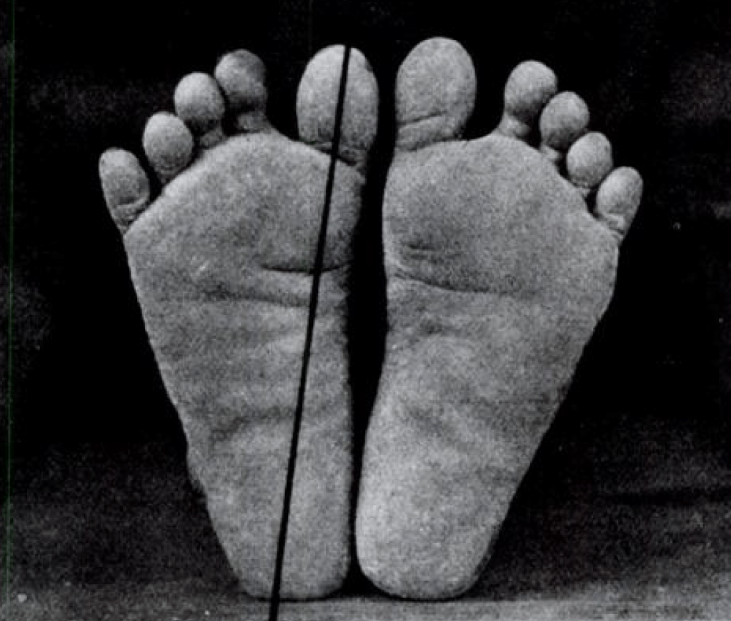 Fig. 1: PLANTAR VIEW OF FEET OF NATURAL FEET, SHOWING STRAIGHTNESS AND SEPARATENESS OF TOES; WIDEST PART OF FOOT AT TOES